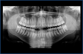 P.A. de Mandíbula - Unimagem Radiografia Odontológica Curitiba